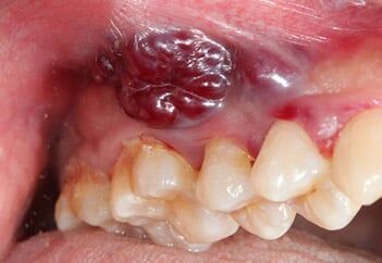 oral-cancer — oral cancer in Schererville, IN oral-cancer — oral cancer in Schererville, IN