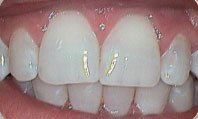 After Teeth Whitening