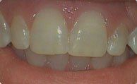 Close-up of front teeth with a small gap between the upper teeth