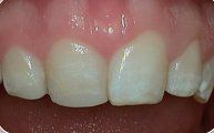 Close-up of front teeth with a slight gap and pink gums in a mouth