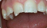 Close-up of upper front teeth with a small gap, above a visible tongue