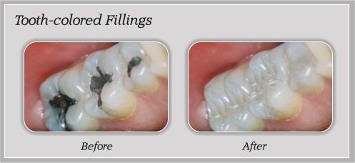 Tooth-colored fillings: damaged molars before and after restoration