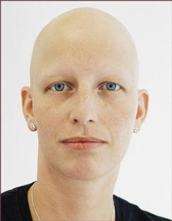 Nahaufnahme einer Alopecia Kundin mit blauen Augen und Ohrringen vor weißem Hintergrund