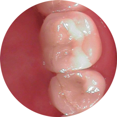 implants