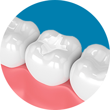 tooth colored fillings