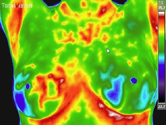 Breast Thermography — Hudson, NY — Serenity Wellness Medical Spa Breast Thermography — Hudson, NY — Serenity Wellness Medical Spa