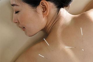 Acupuncture —  Kansas City, MO — Heartland Yoga & Acupuncture