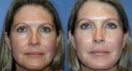 prima e dopo un trattamento peeling