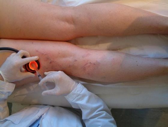 fleboterapia rigenerativa tridimensionale