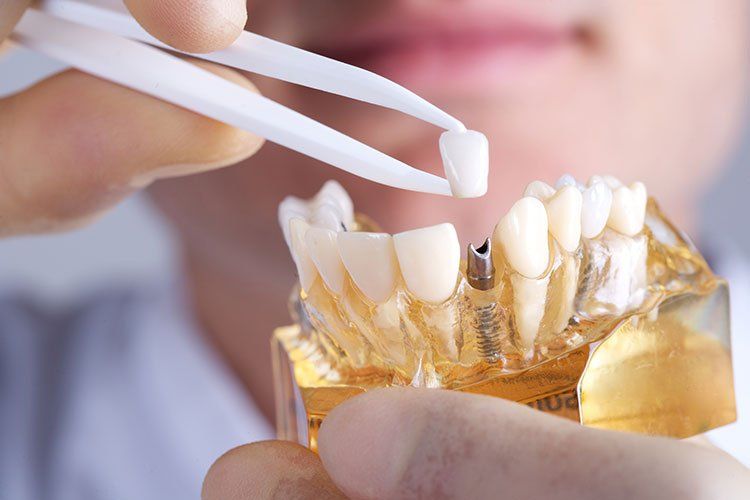 Dentist's hand holding a tooth crown with tweezers, positioning it over a model of teeth with a dental implant.