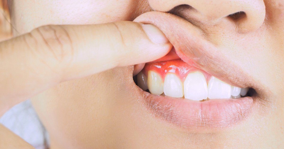 gingivitis