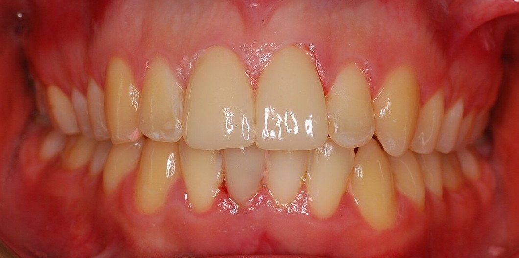 after fastbraces