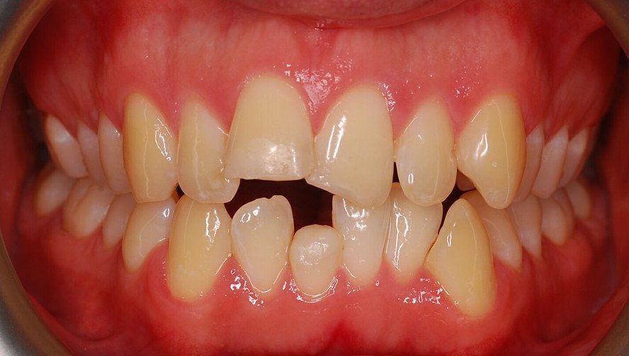 before fastbraces