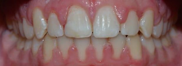 after fastbraces 2