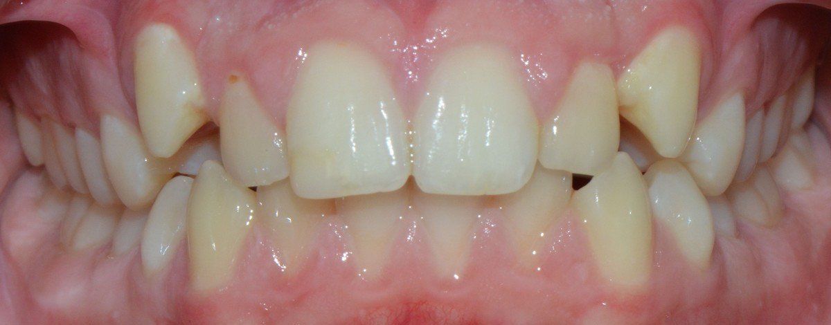 before fastbraces 2