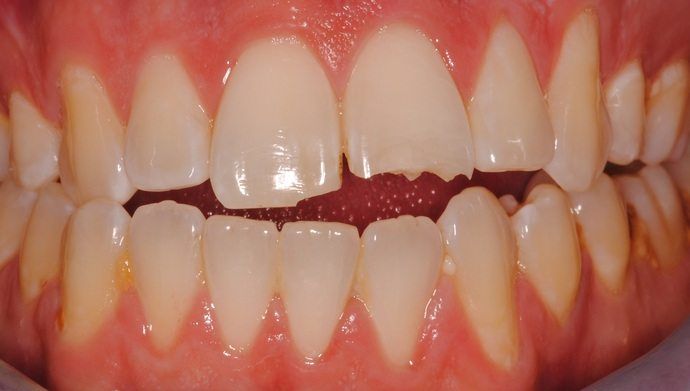 smile makeover before, cosmetic dentistry
