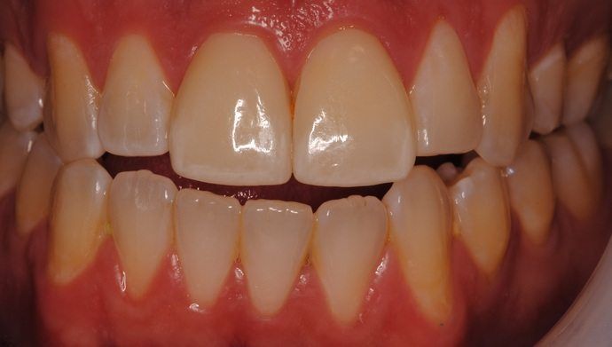 smile makeover, cosmetic dentistry