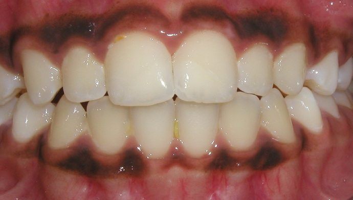smile makeover after, cosmetic dentistry