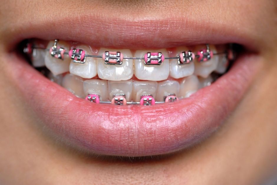 apparecchio dentale fisso