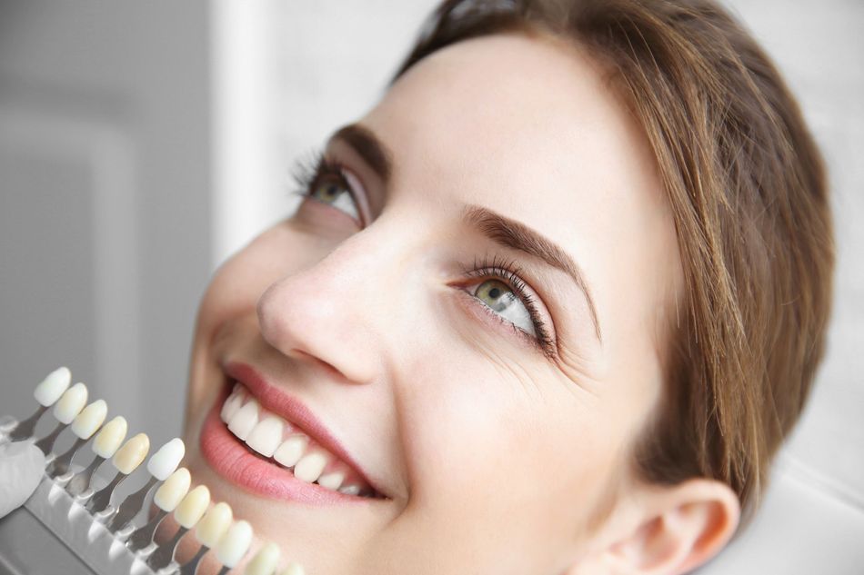 applicazione di faccette dentali