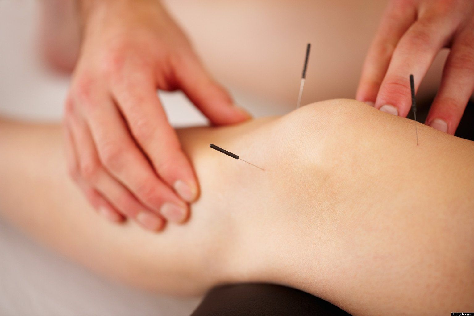 What is Acupuncture?