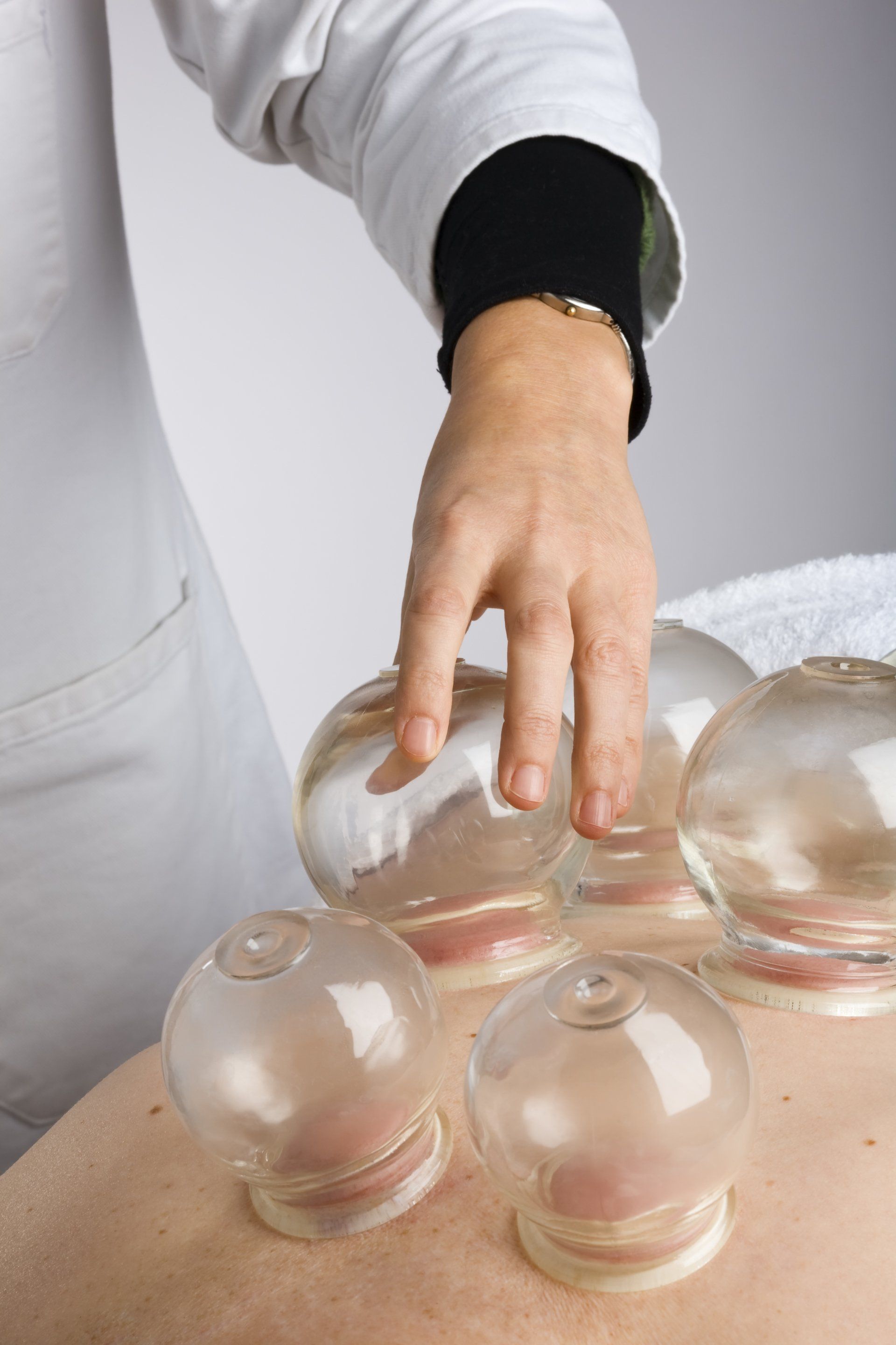 Cupping Therapy