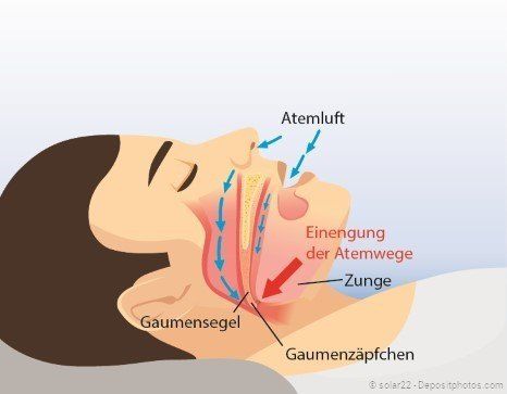 Anatomie der oberen Atemwege beim Schnarchen Anatomie der oberen Atemwege beim Schnarchen