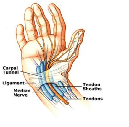 Carpal Tunnel Syndrome Carpal Tunnel Syndrome