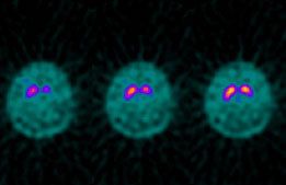 Parkinsons disease