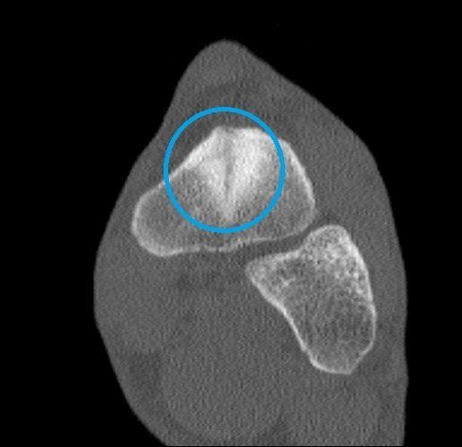 Nav Coronal CT