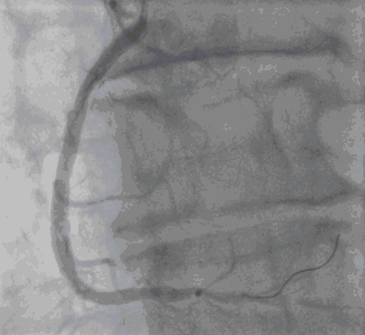 mit Stent