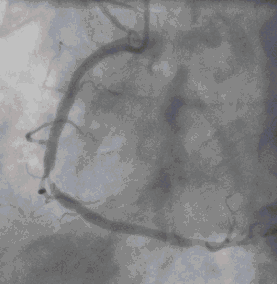 kein Stent