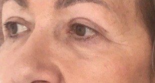 risultato su paziente di intervento di blefaroplastica - 6