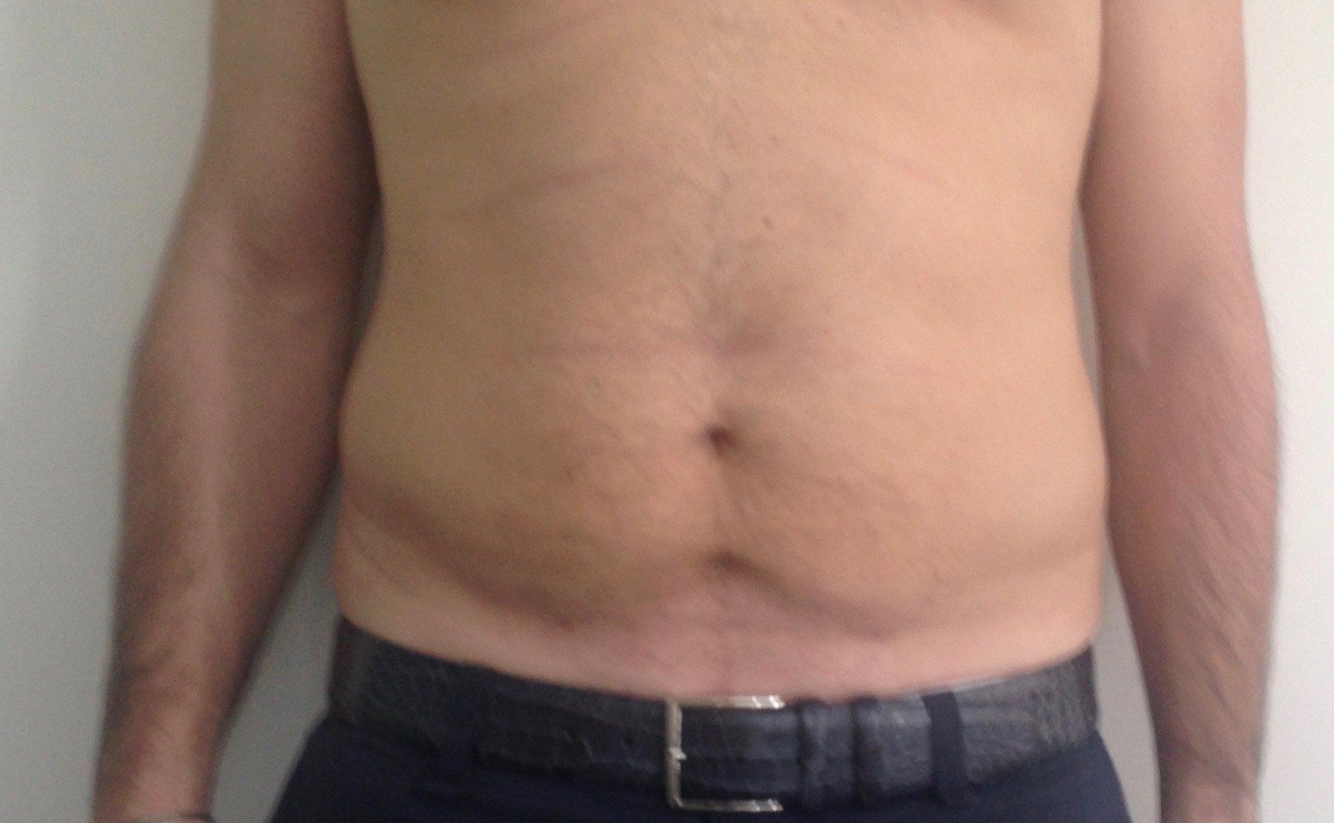 risultato su paziente E di intervento di liposuzione