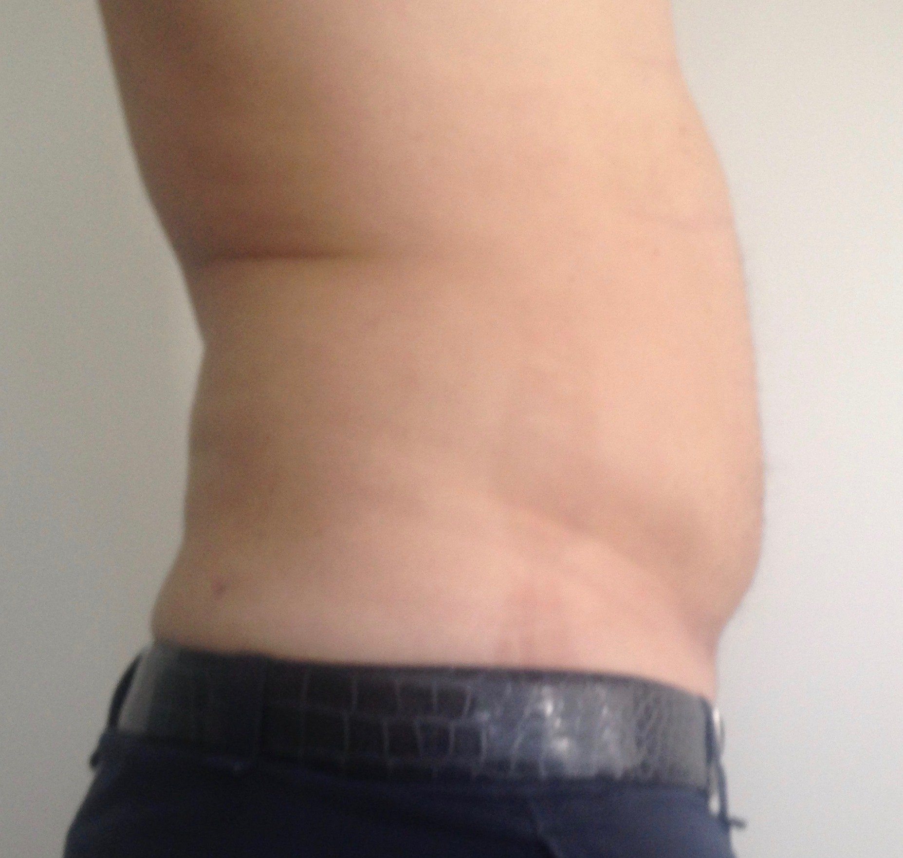 risultato su paziente D di intervento di liposuzione