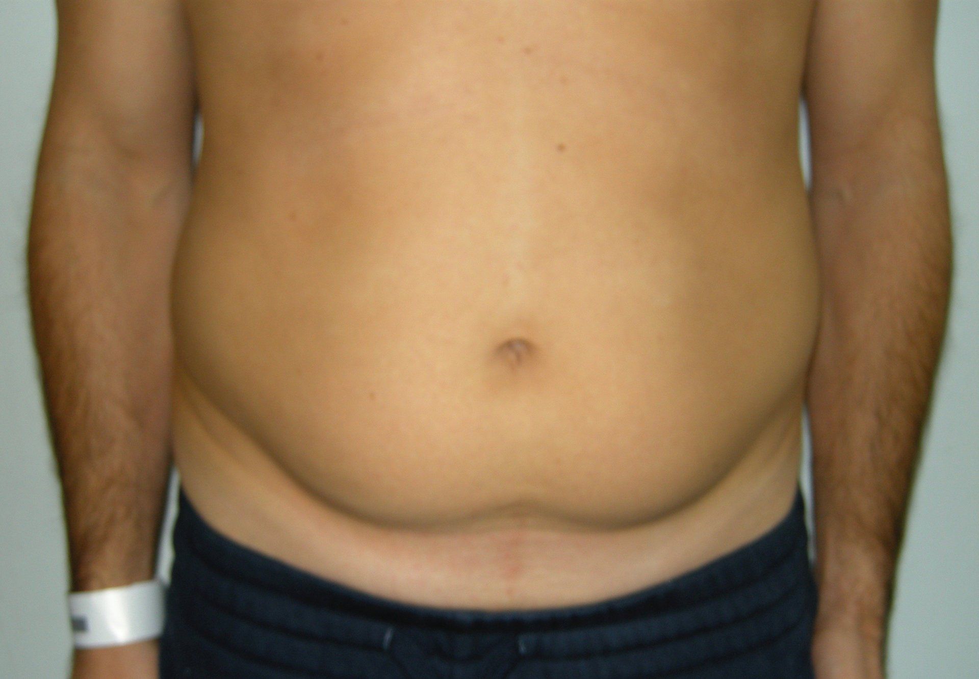 paziente E prima di sottoporsi a intervento di liposuzione