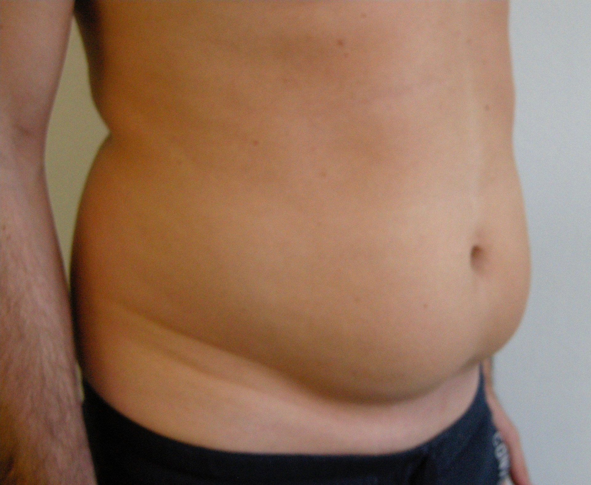 paziente D prima di sottoporsi a intervento di liposuzione