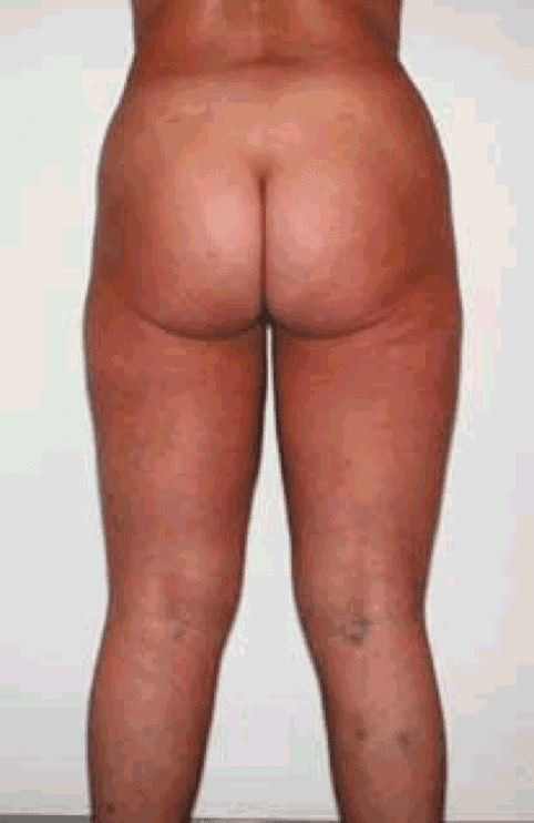 risultato su paziente G di intervento di liposuzione