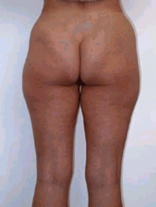 paziente F prima di sottoporsi a intervento di liposuzione
