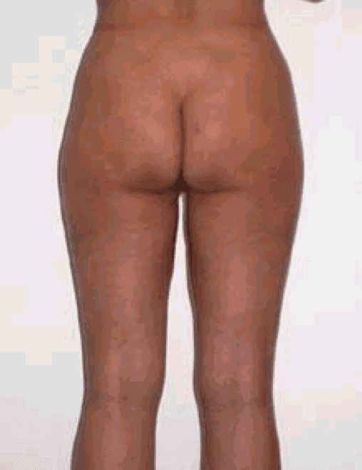 risultato su paziente F di intervento di liposuzione