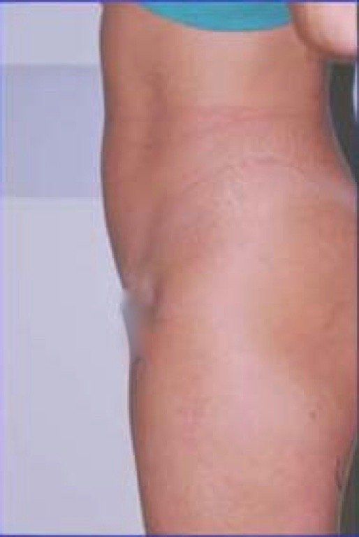 risultato su paziente C di intervento di liposuzione