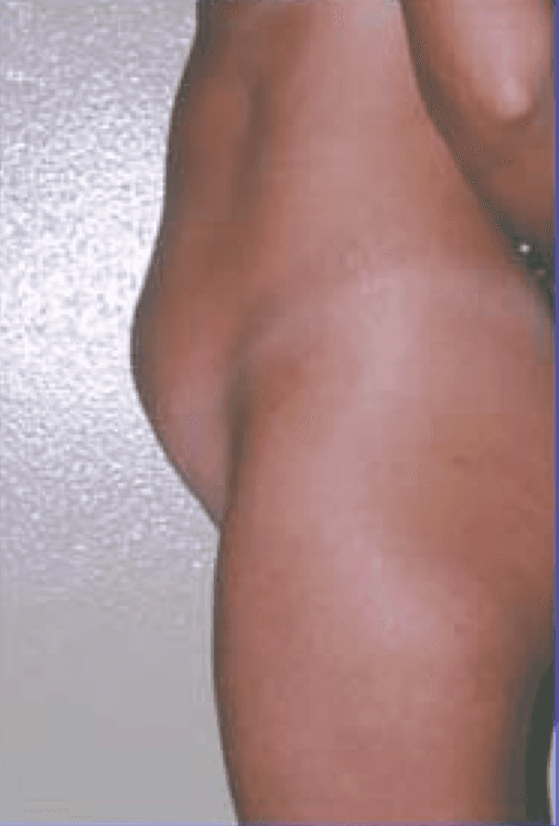 paziente C prima di sottoporsi a intervento di liposuzione