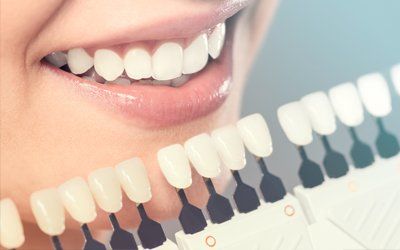 Porcelain Veneers — Cosmetic Dentistry in Vacaville, CA Porcelain Veneers — Cosmetic Dentistry in Vacaville, CA