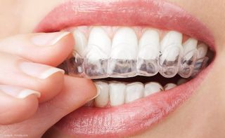 Home-Bleaching: Einsetzen der Bleaching-Folien