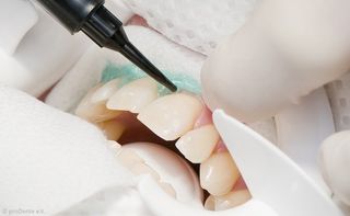 Power-Bleaching: Zahnfleischschutz