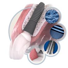 Astra Tech Dentsply Sirona Implant Systems