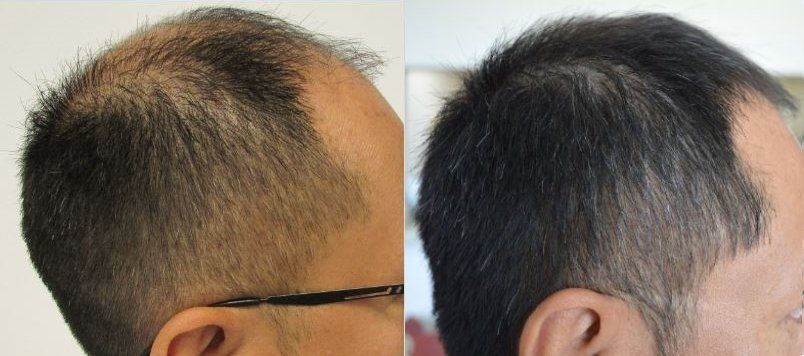 Hair Loss Treatment