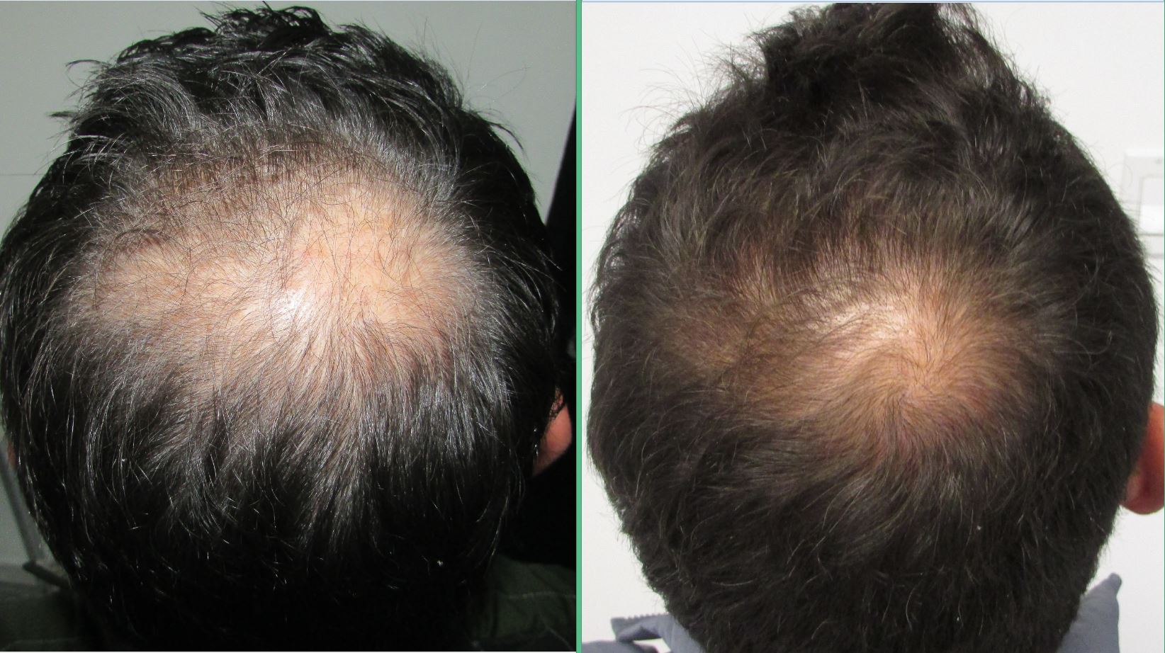 Best hair regrowth product