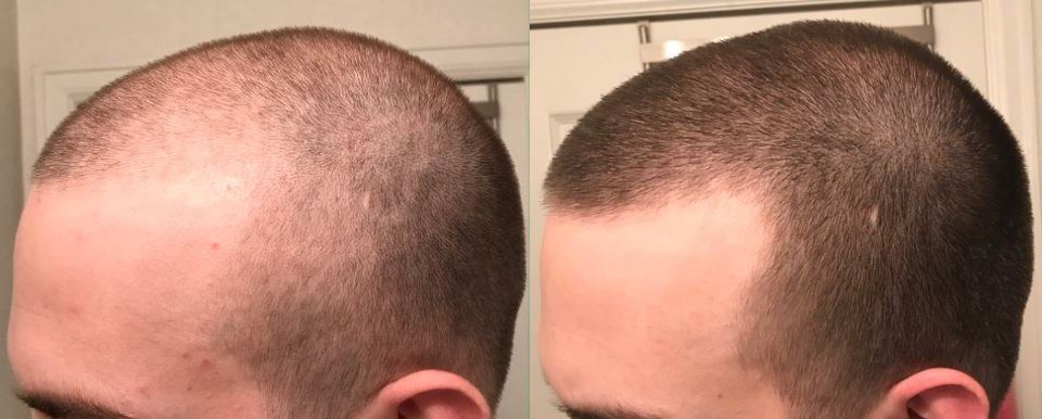 Best hair regrowth product