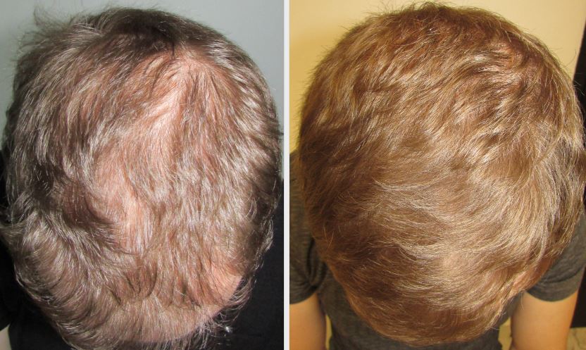 Hair Loss Treatment